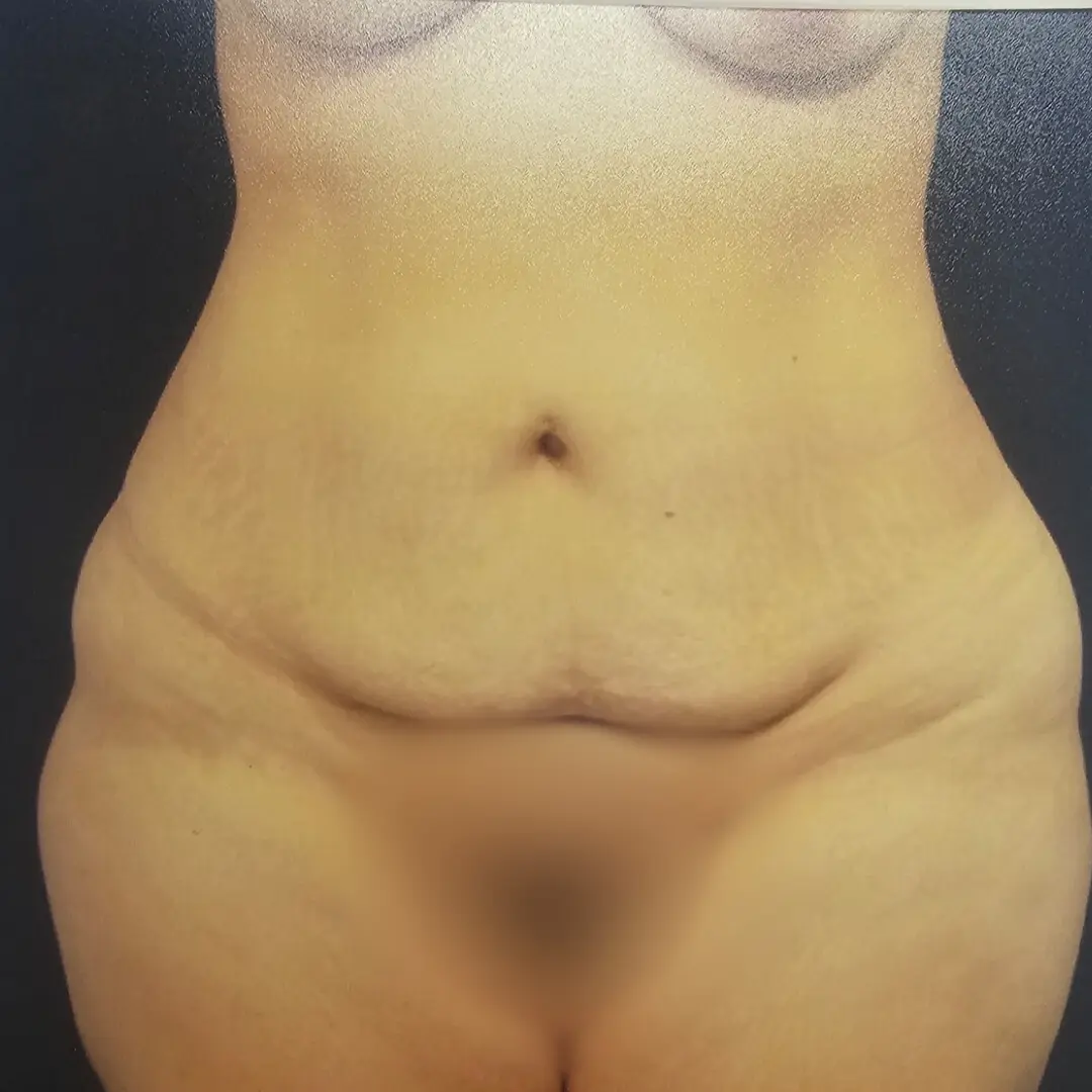 Galería: Dra Cirugía 115 Abdomino sin liposuccion antes