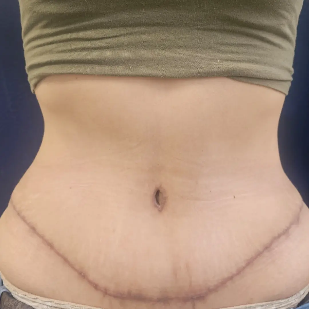 Galería: Dra Cirugía 116 Abdomino sin liposuccion despues