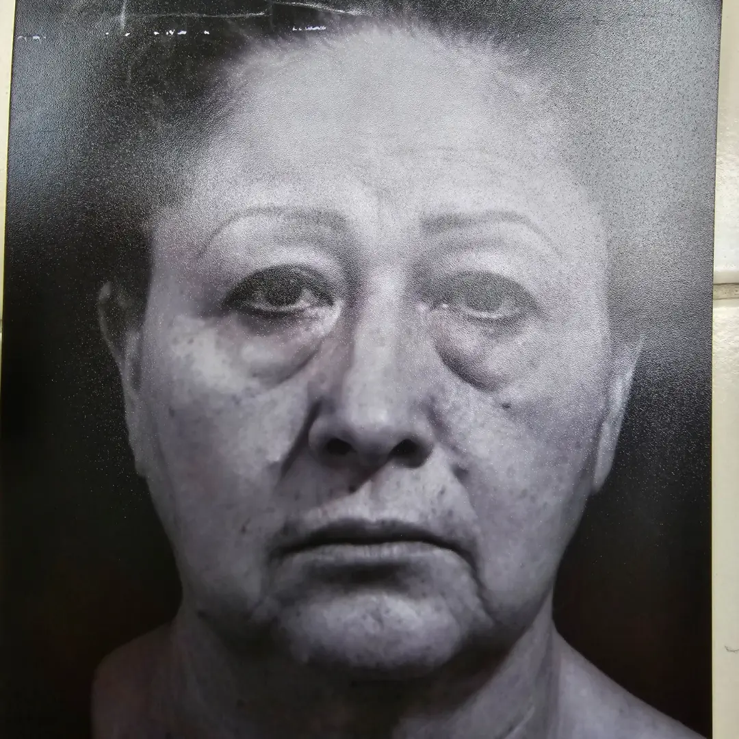 Galería: Dra Cirugía 199 Antes 16