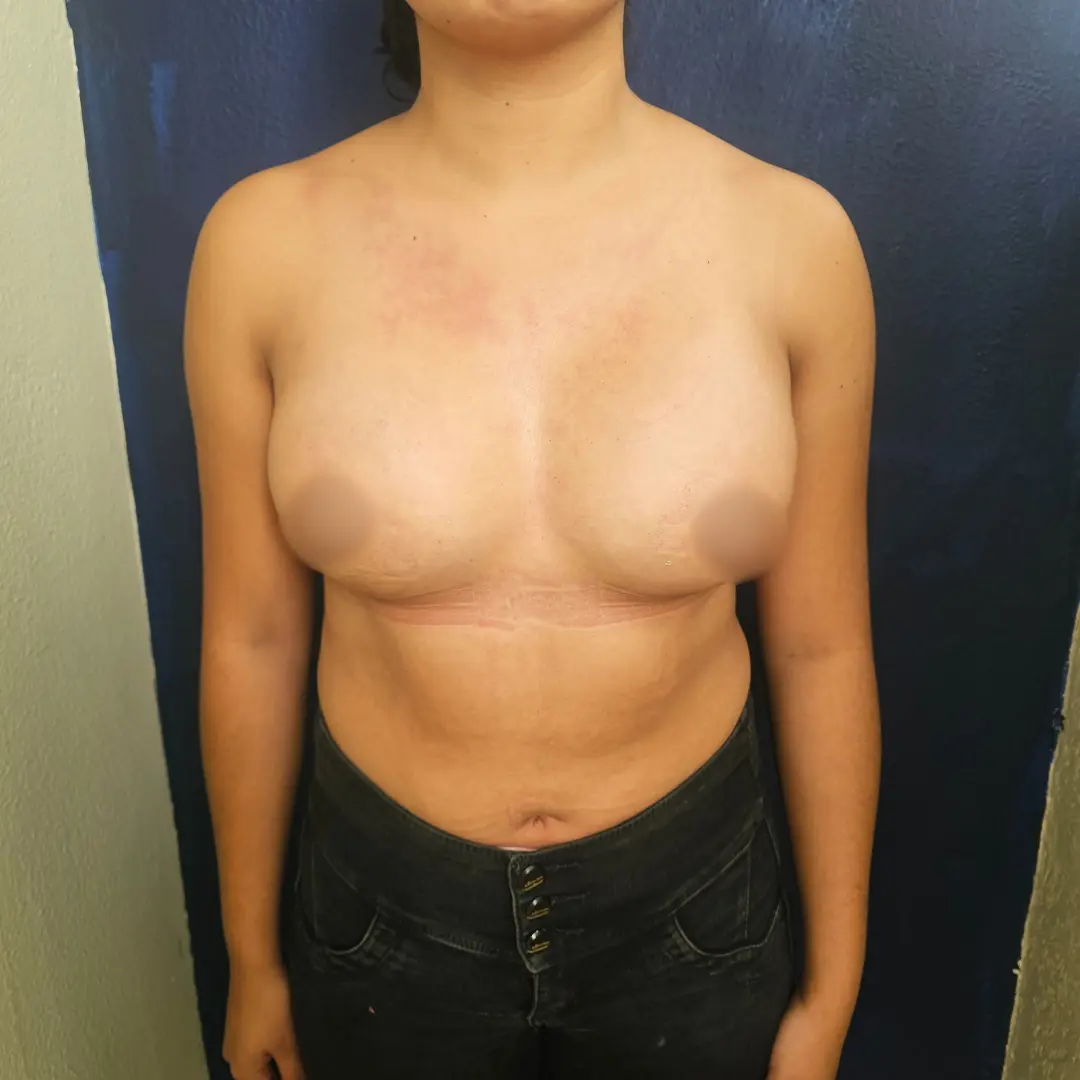 Galería: Dra Cirugía 152 Despues 4