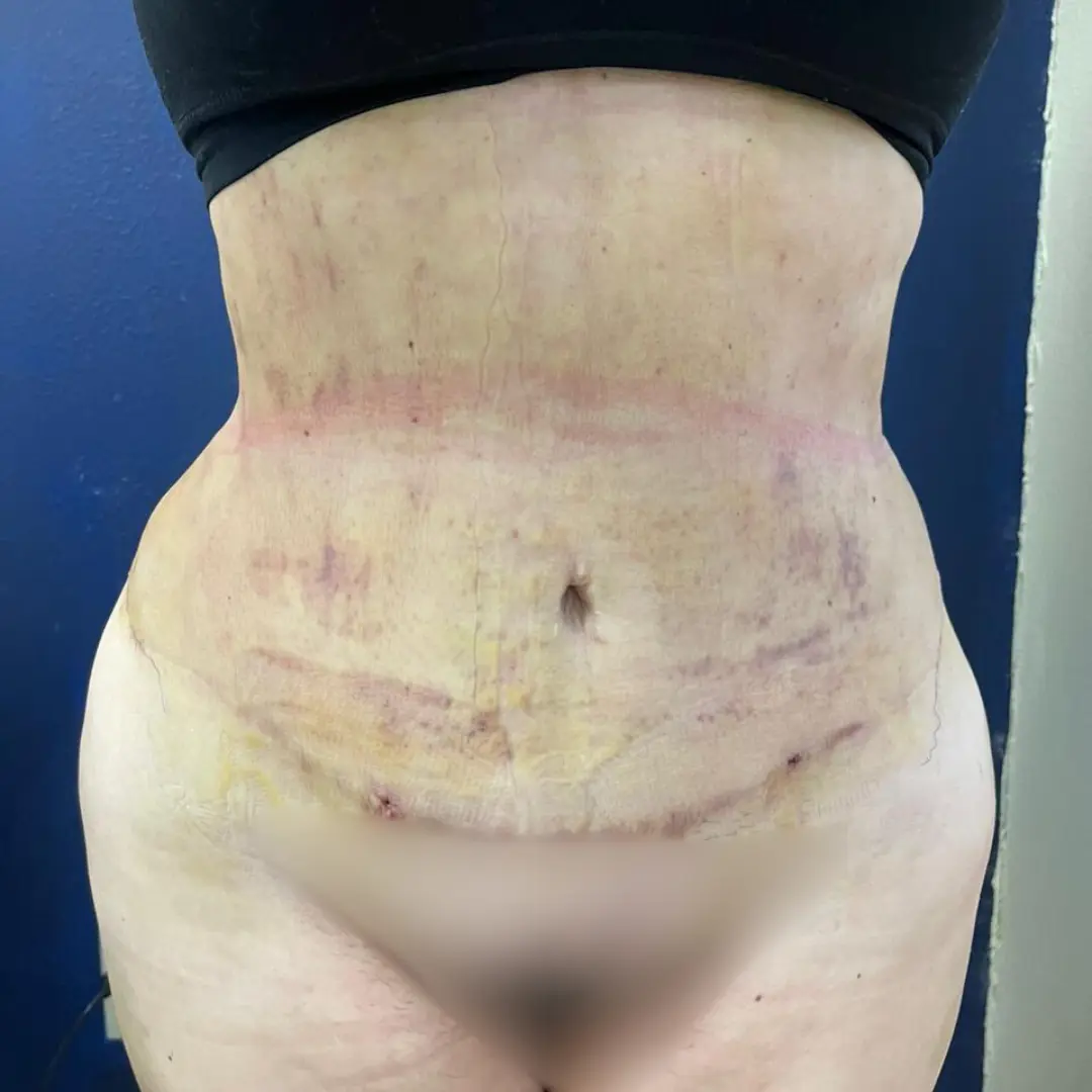Galería: Dra Cirugía 122 Lipo 8