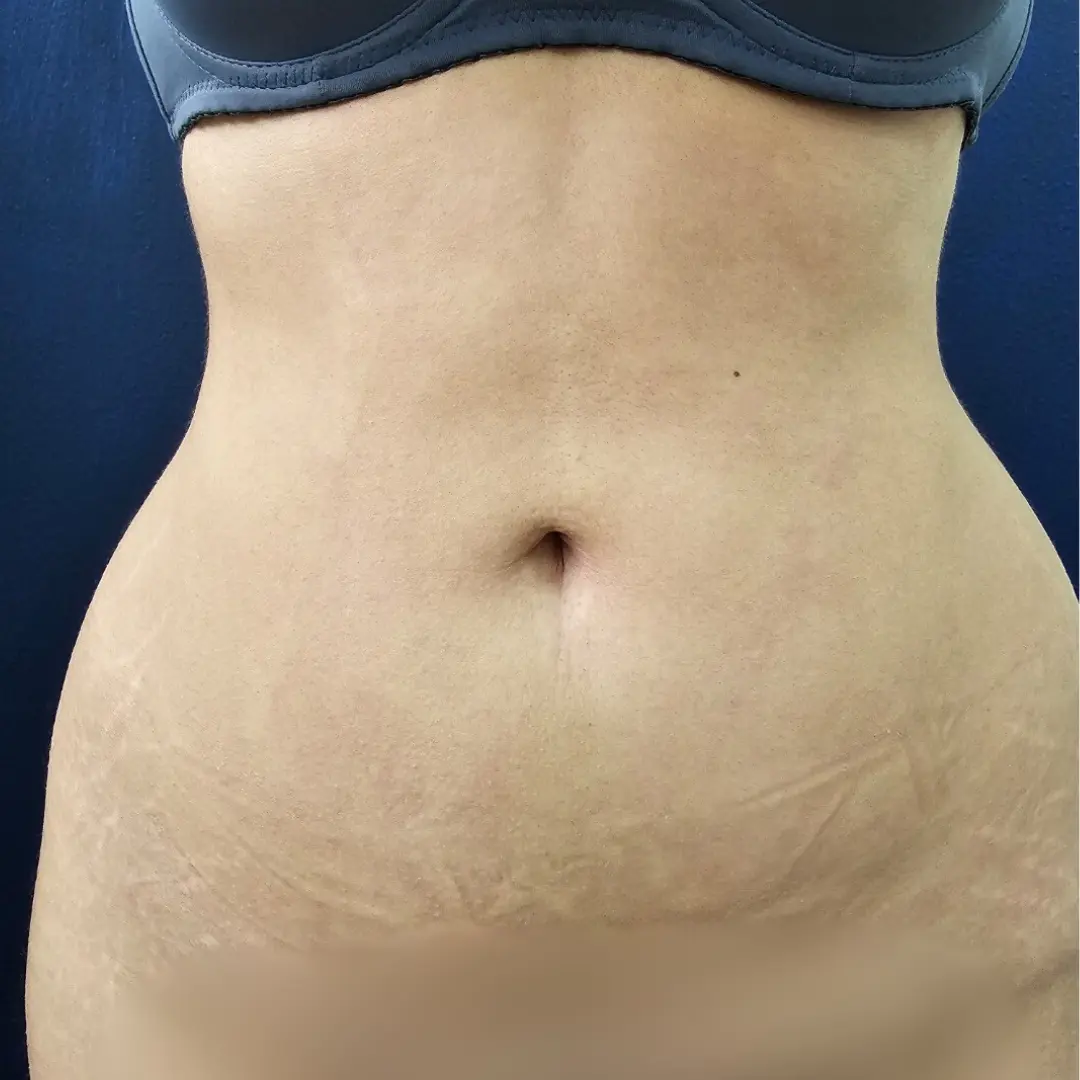 Liposuccion mas pexia umbligal despues