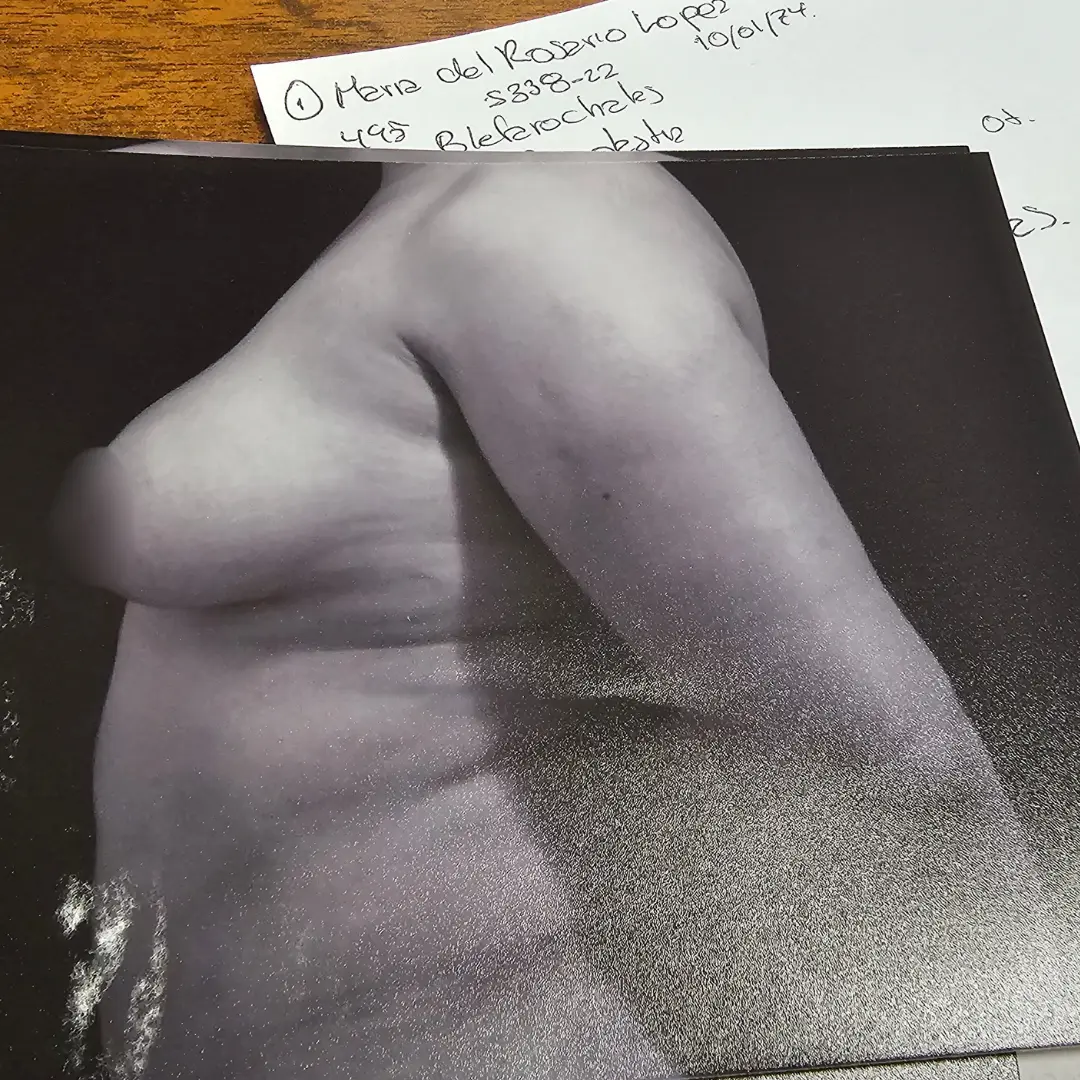 Galería: Dra Cirugía 137 Mamoplastia 2