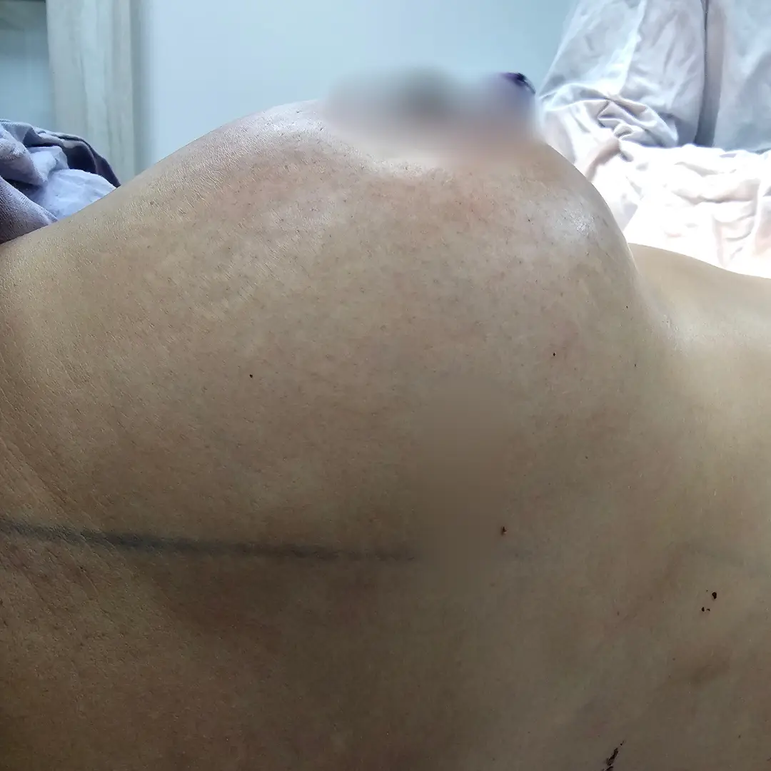 Galería: Dra Cirugía 138 Mamoplastia 3