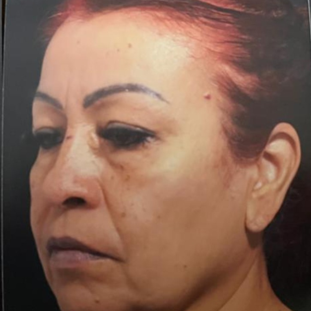 Galería: Dra Cirugía 177 Retidoplastia Antes