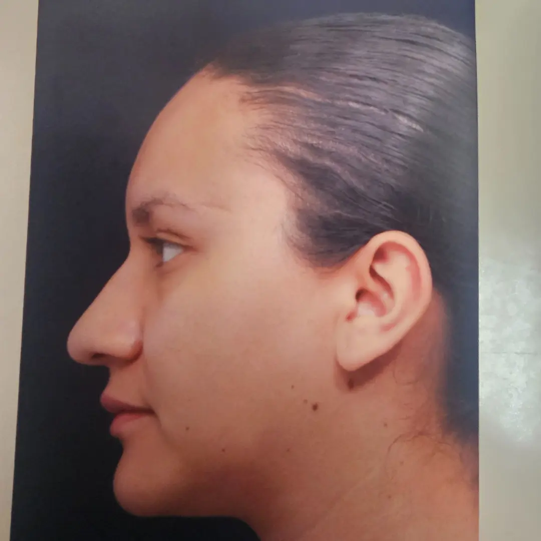 Galería: Dra Cirugía 180 Rinoplastia antes
