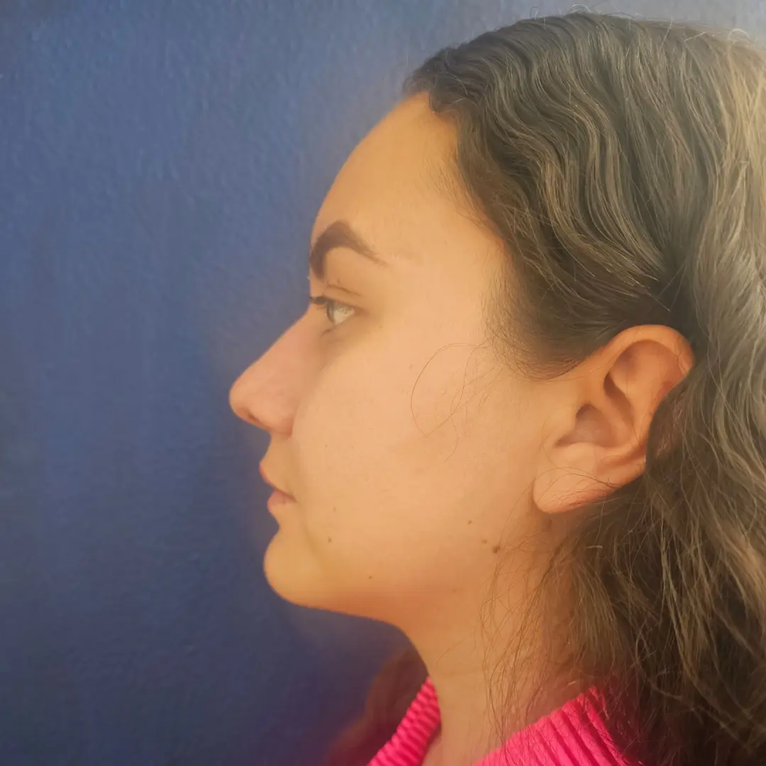 Galería: Dra Cirugía 179 Rinoplastia despues